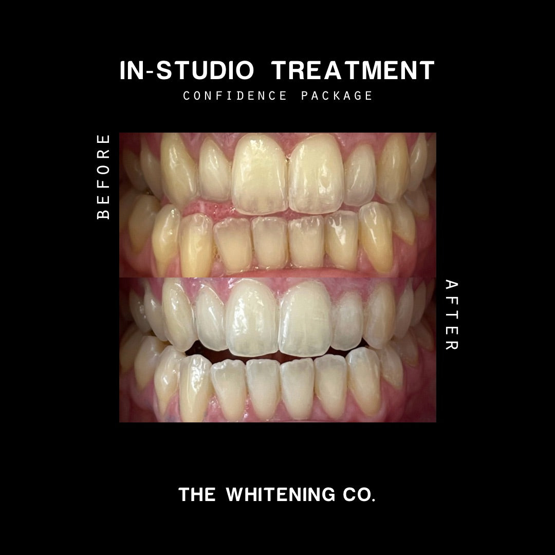 Gift Voucher: The Confidence Package (In-Studio Whitening)