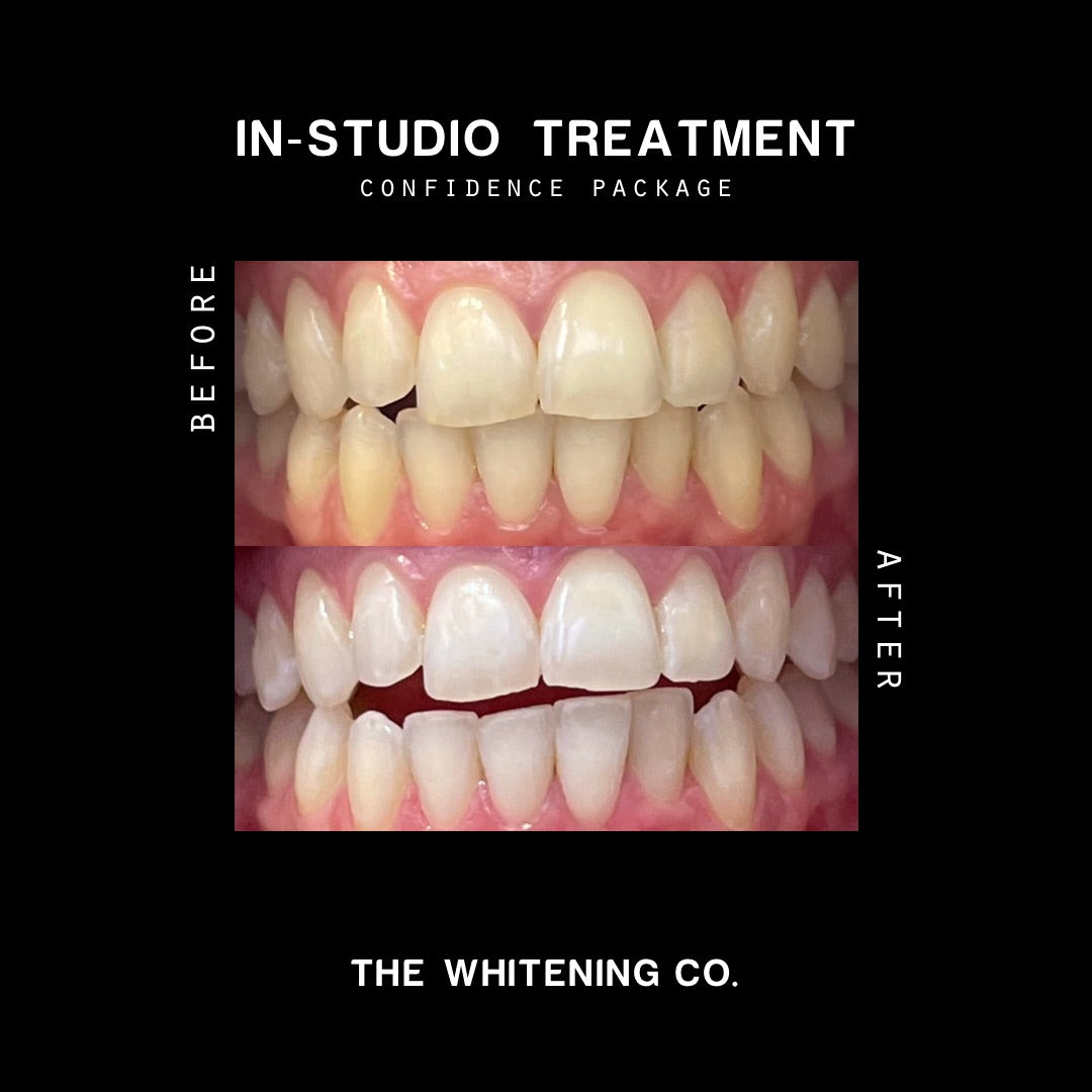 Gift Voucher: The Confidence Package (In-Studio Whitening)