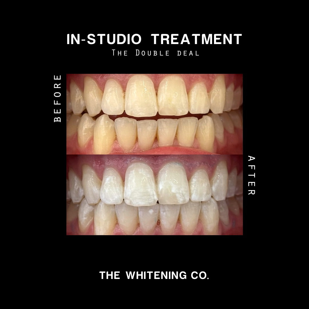 Gift Voucher: The Double Deal (In-Studio Whitening)