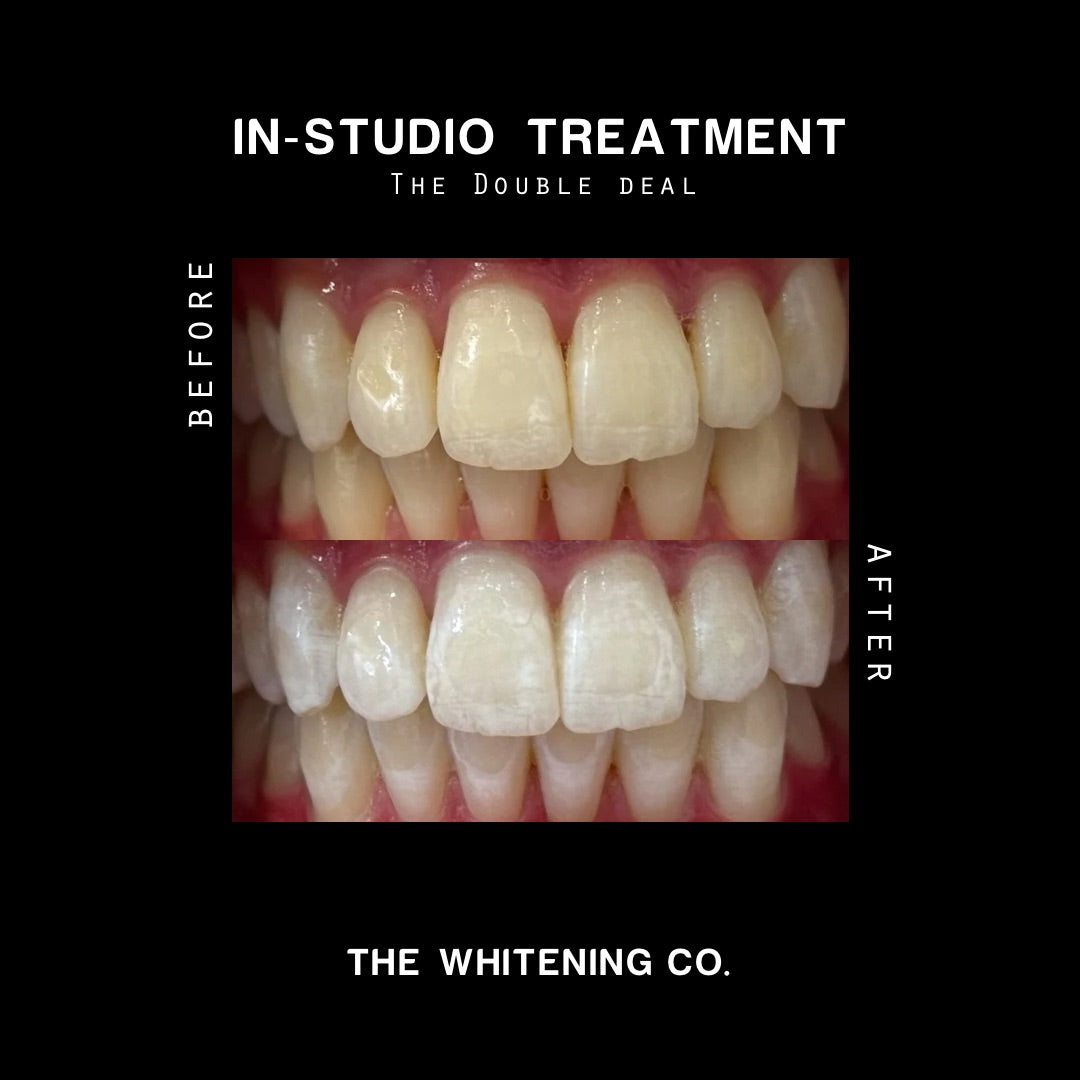Gift Voucher: The Double Deal (In-Studio Whitening)