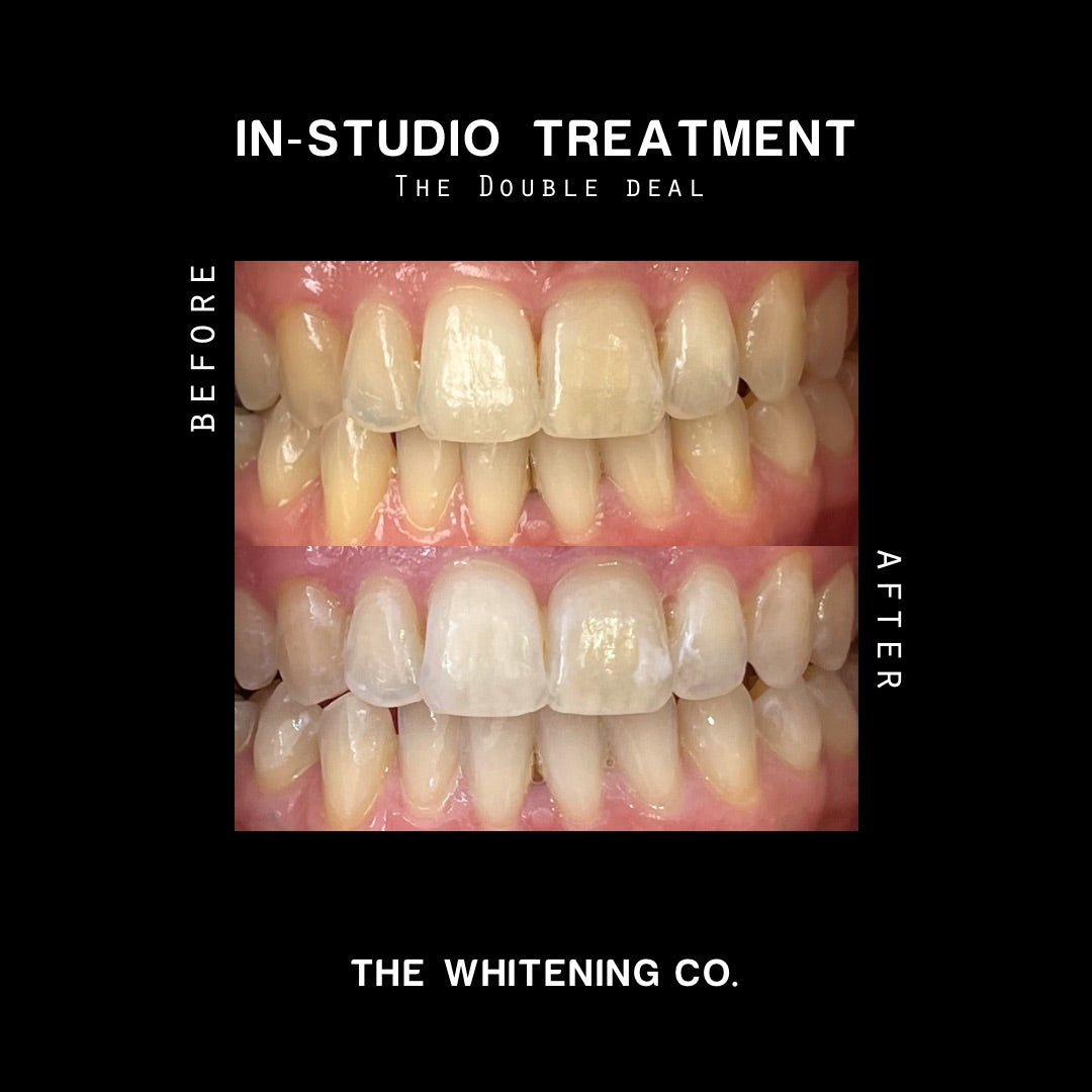 Gift Voucher: The Double Deal (In-Studio Whitening)