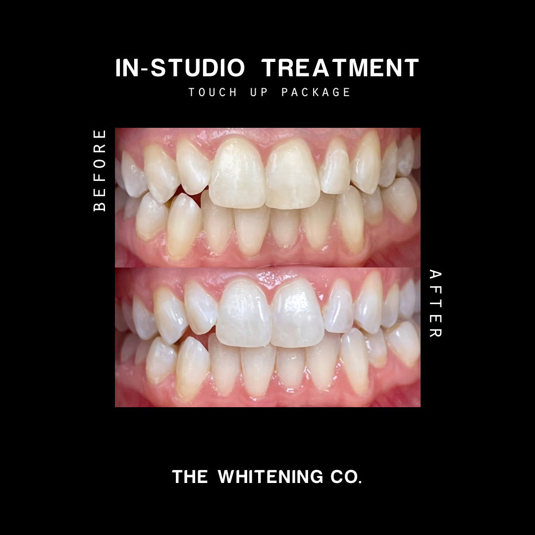 Gift Voucher: The Touch Up Package (In-Studio Whitening)