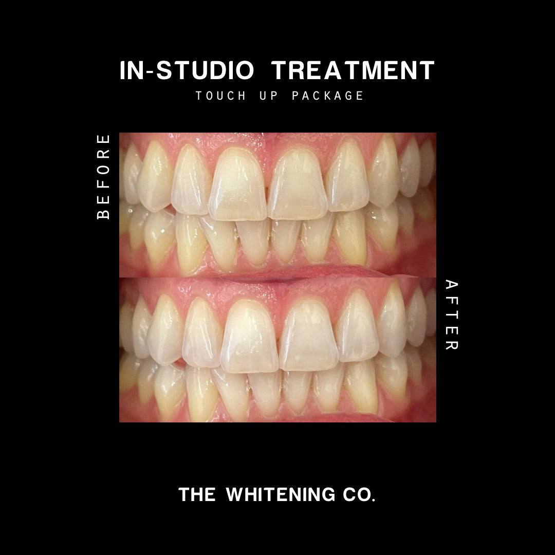 Gift Voucher: The Touch Up Package (In-Studio Whitening)