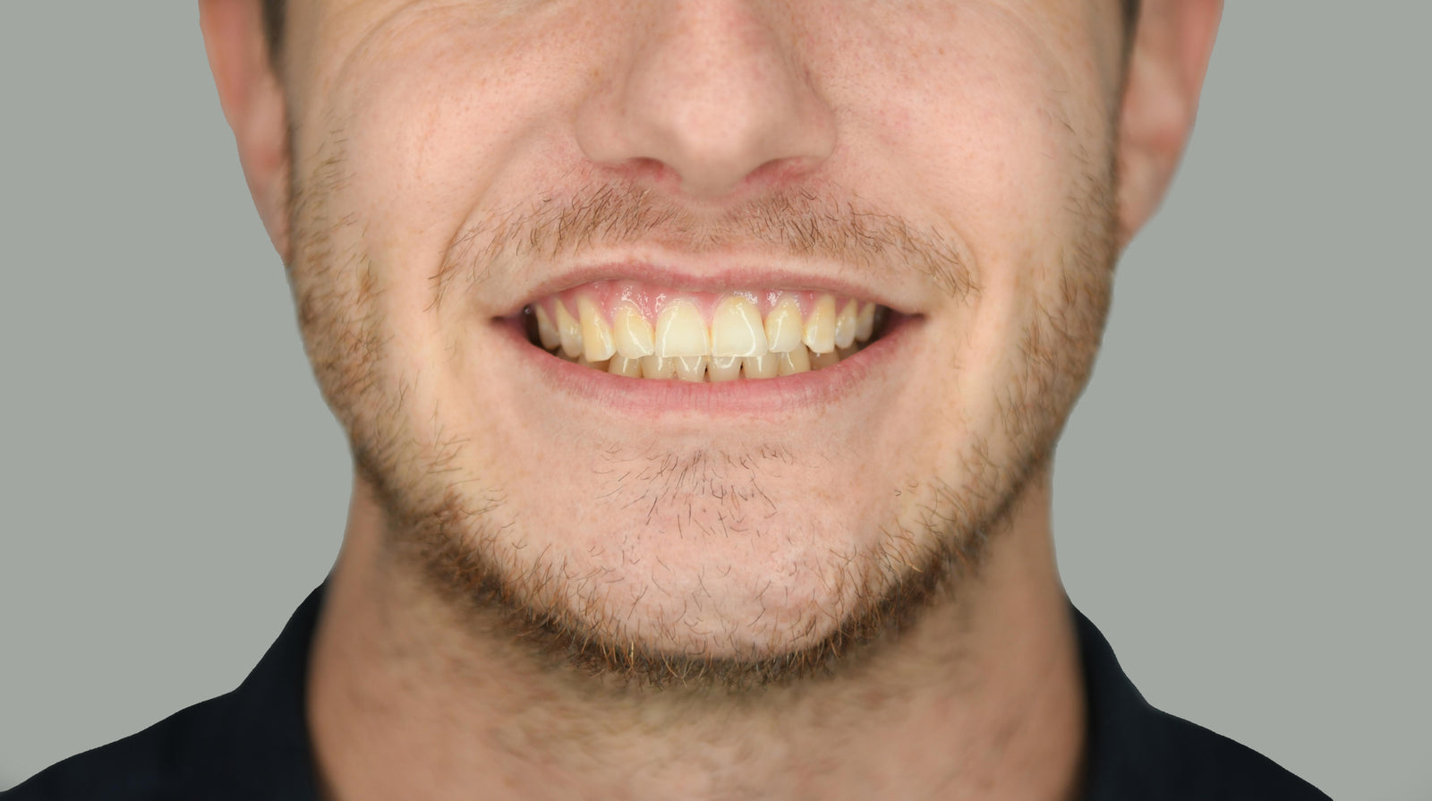 Real customer smile before whitening