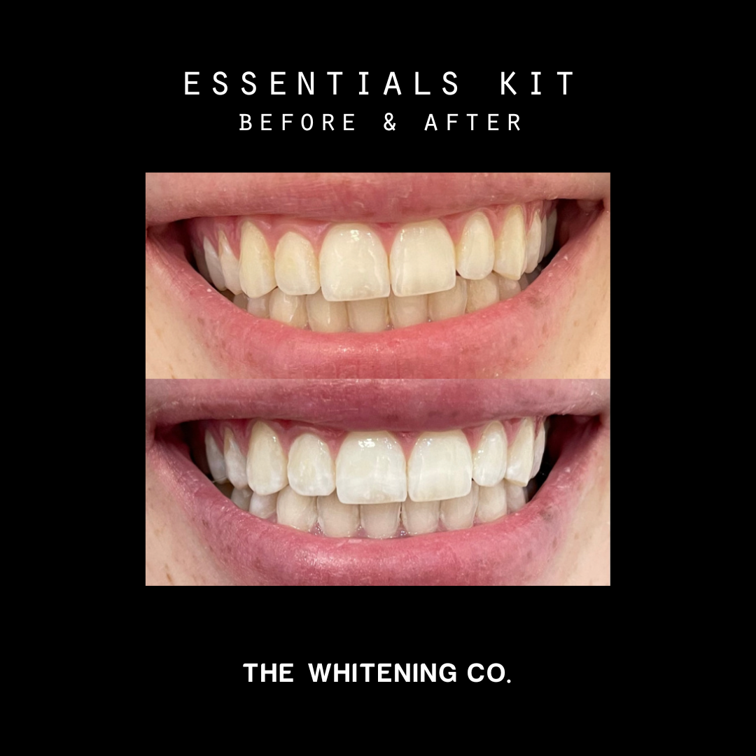 The Essentials Kit - Premium at Home Teeth Whitening Kit