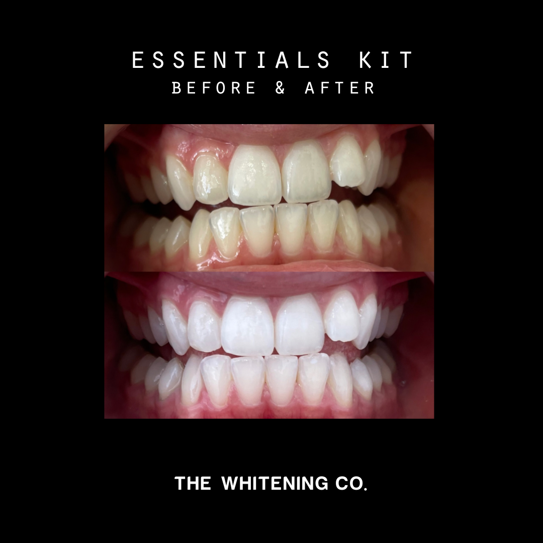 The Essentials Kit - Premium at Home Teeth Whitening Kit