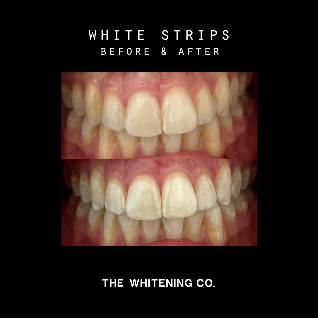 White Strips x14 - Teeth Whitening Strips