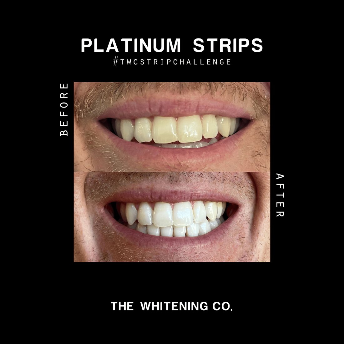 Before and after teeth whitening results using The Whitening Co Platinum Strips