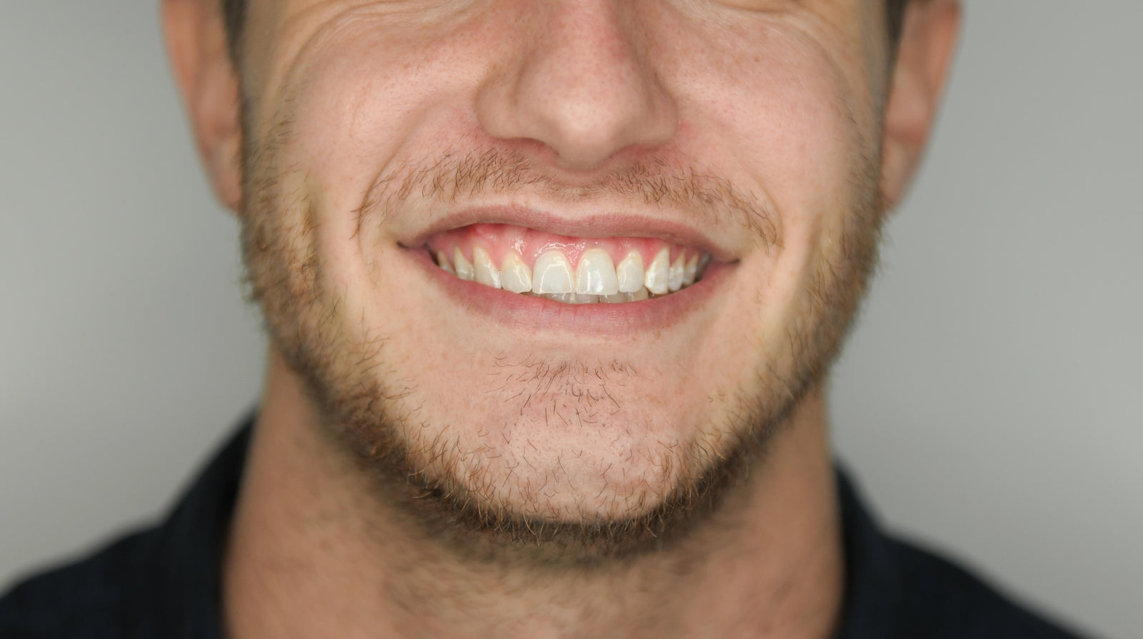 The same smile after The Whitening Co in-studio whitening